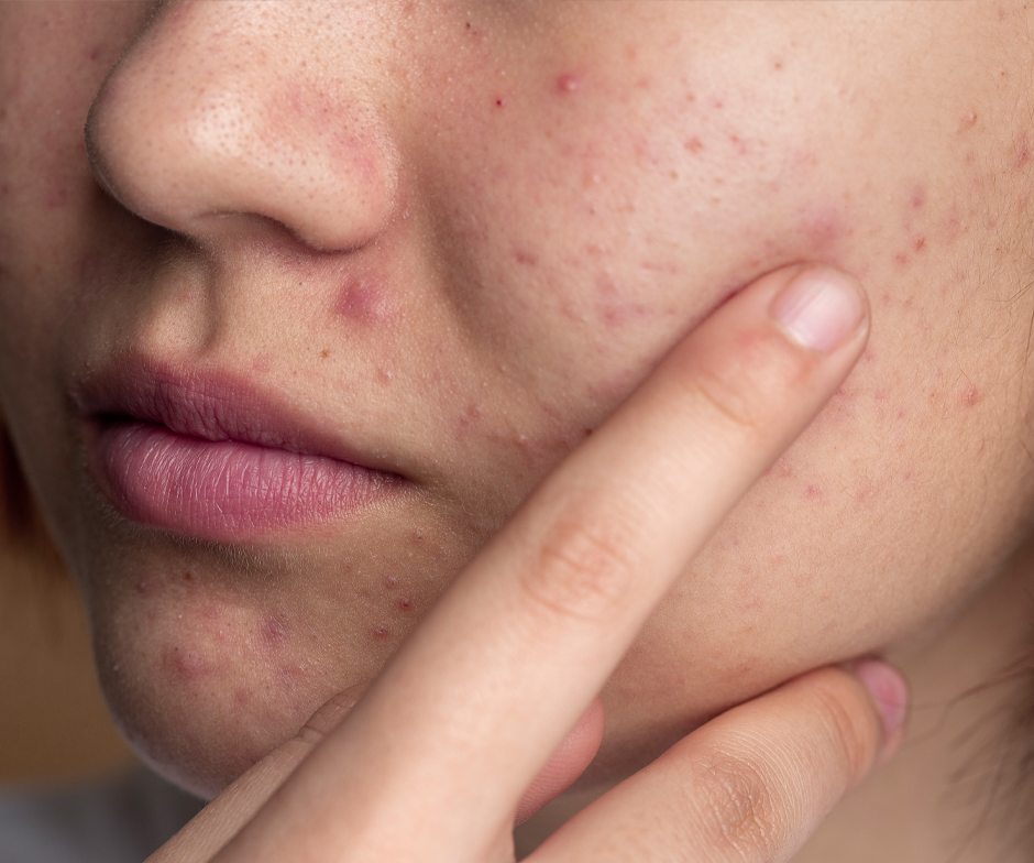 成人暗瘡點算好？教你由根源擊退頑固痘痘