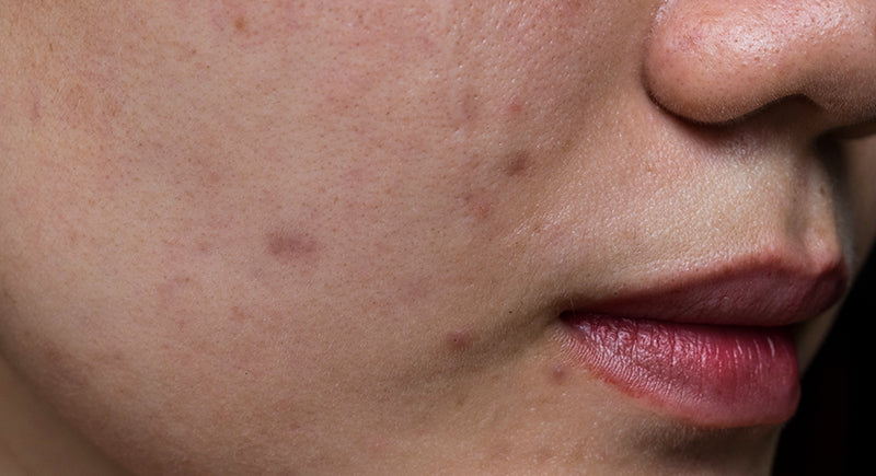 black-spots-scars-acne-face-asian-young-woman
