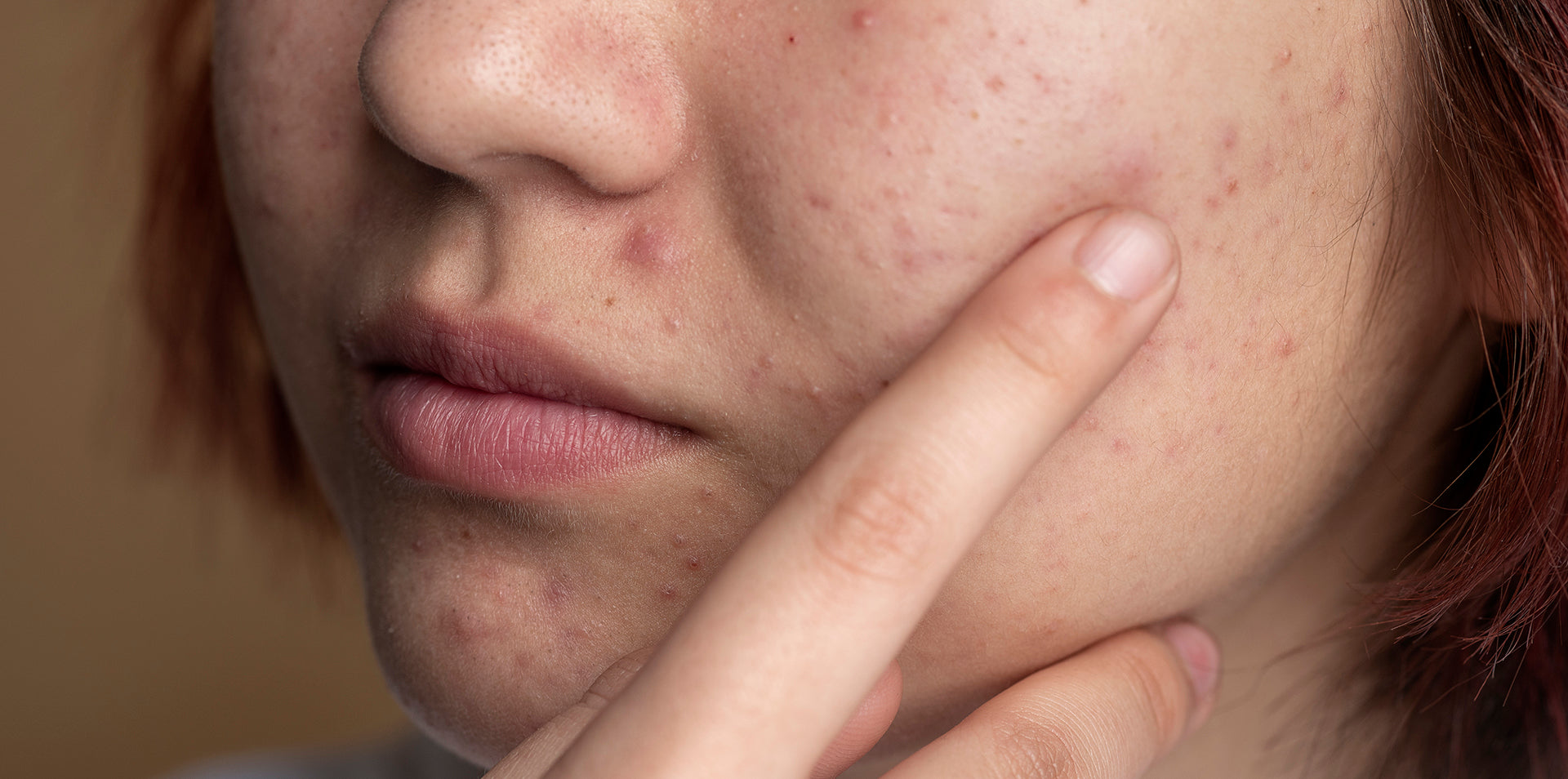 Daily-habits-that-cause-chin-breakouts-and-clogged-pores