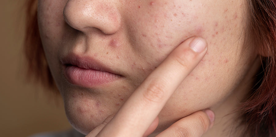 Daily-habits-that-cause-chin-breakouts-and-clogged-pores